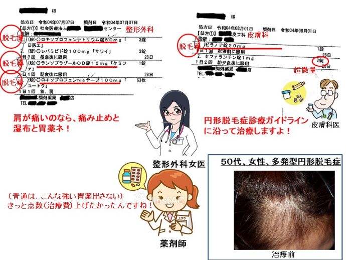 円形脱毛症　病院